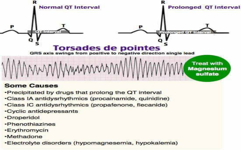 Torsades de Pointes